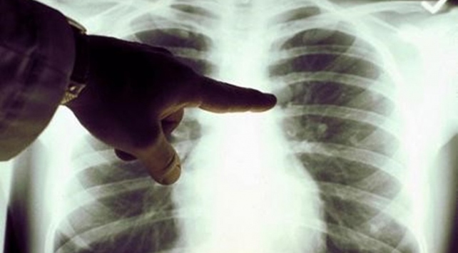 Pandemide akciğer kanseri tanısı 5 kat arttı: Geçmeyen öksürüğe dikkat