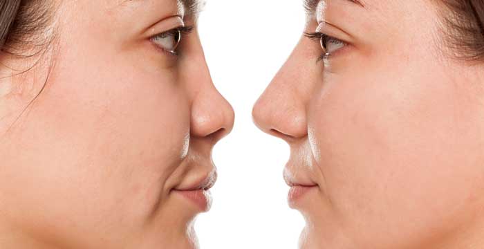 Burun estetiği rinoplasti nedir? Hangi sorunlarda yapılır? Nelere dikkat edilmeli?