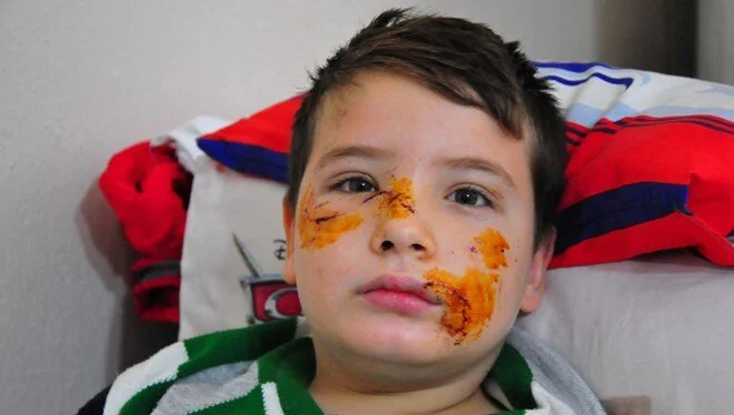 Köpek saldırısına uğrayan 8 yaşındaki Mert'in yüzüne 60 dikiş atıldı