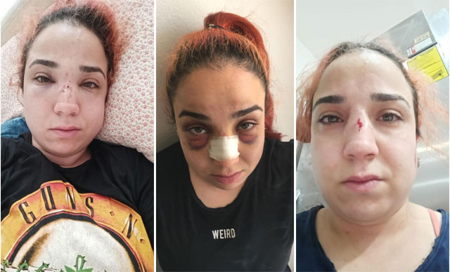 Kadın çalışanın burnunu kıran patrona 4,5 yıla kadar hapis istemi