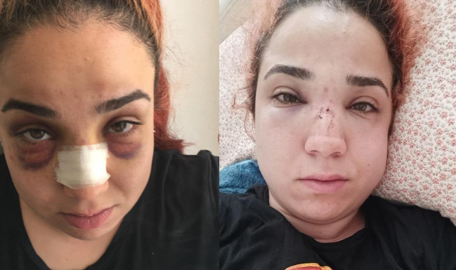 Patronu tarafından burnu kırılan kadına hapis istemi