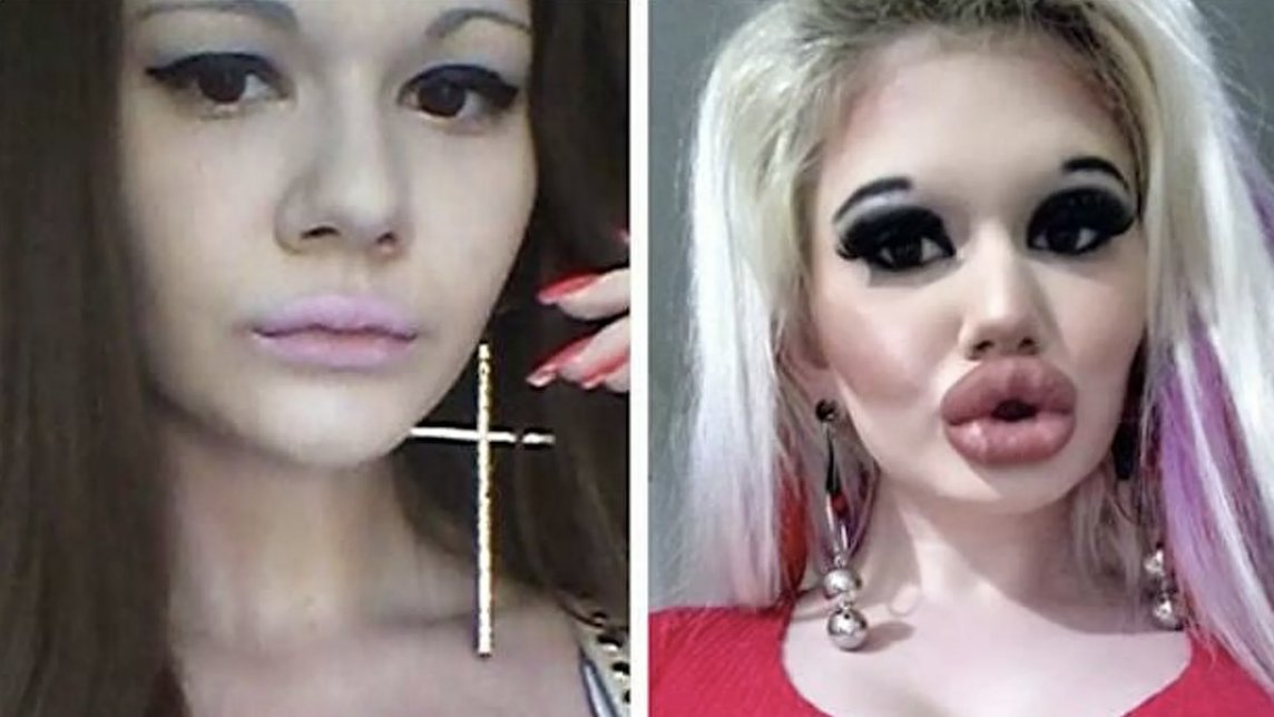 Dünyanın en büyük dudaklı kadını 27. operasyon için sırada