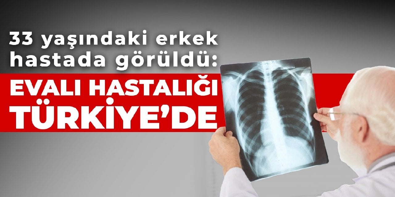 33 yaşındaki erkek hastada görüldü: EVALI hastalığı Türkiye’de