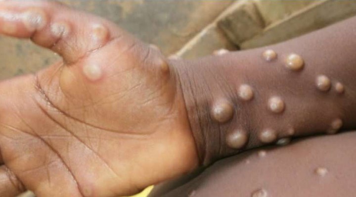 Meksika'da ilk maymun çiçeği vakası hastaneden kaçtı