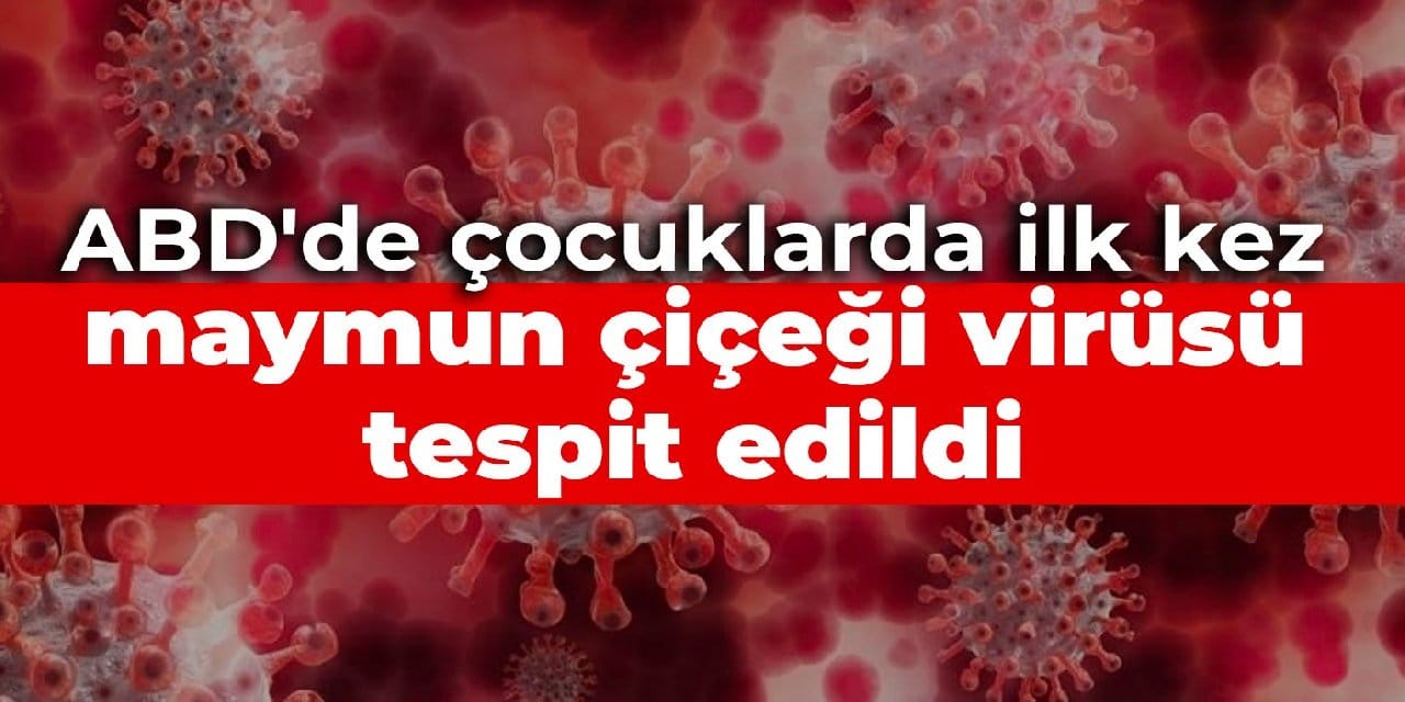 ABD'de çocuklarda ilk kez maymun çiçeği virüsü tespit edildi