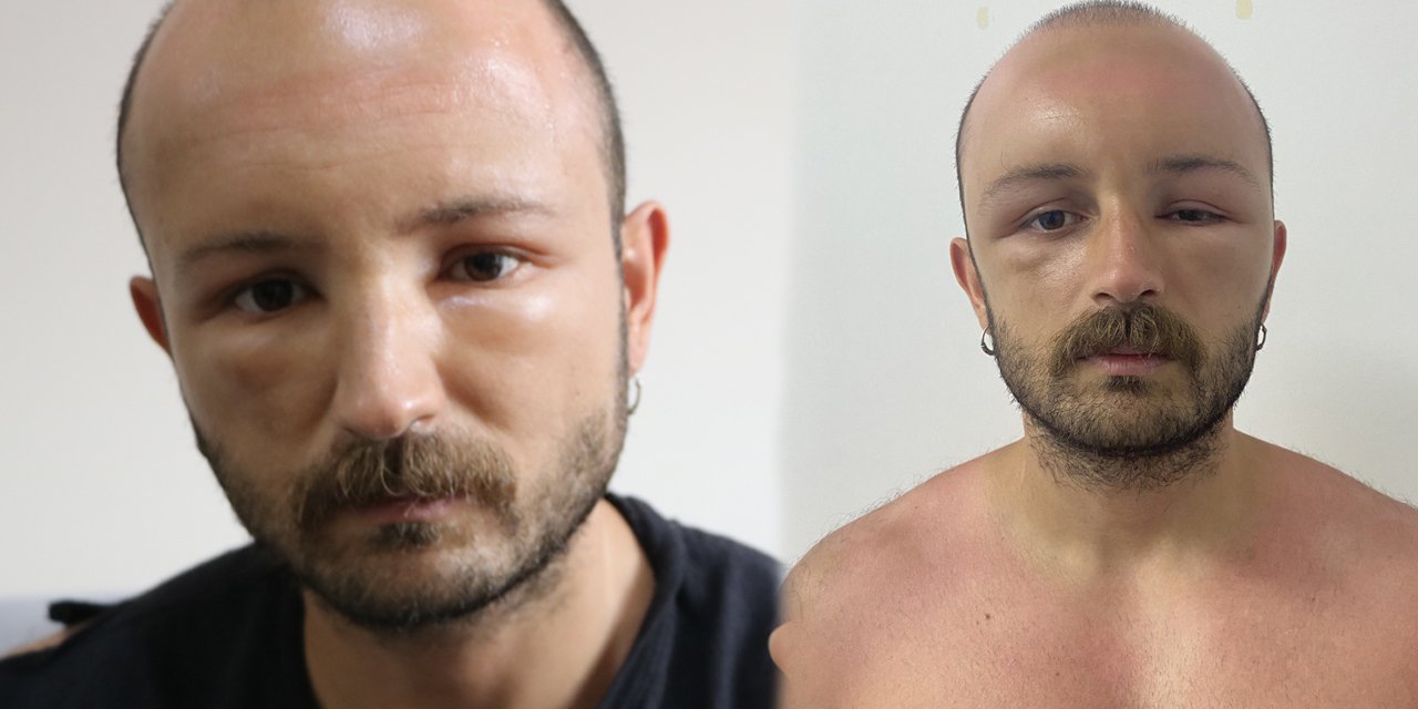 Daha önce hiç görülmeyen bir vaka: 2 gün plaja gitti, başına gelmeyen kalmadı