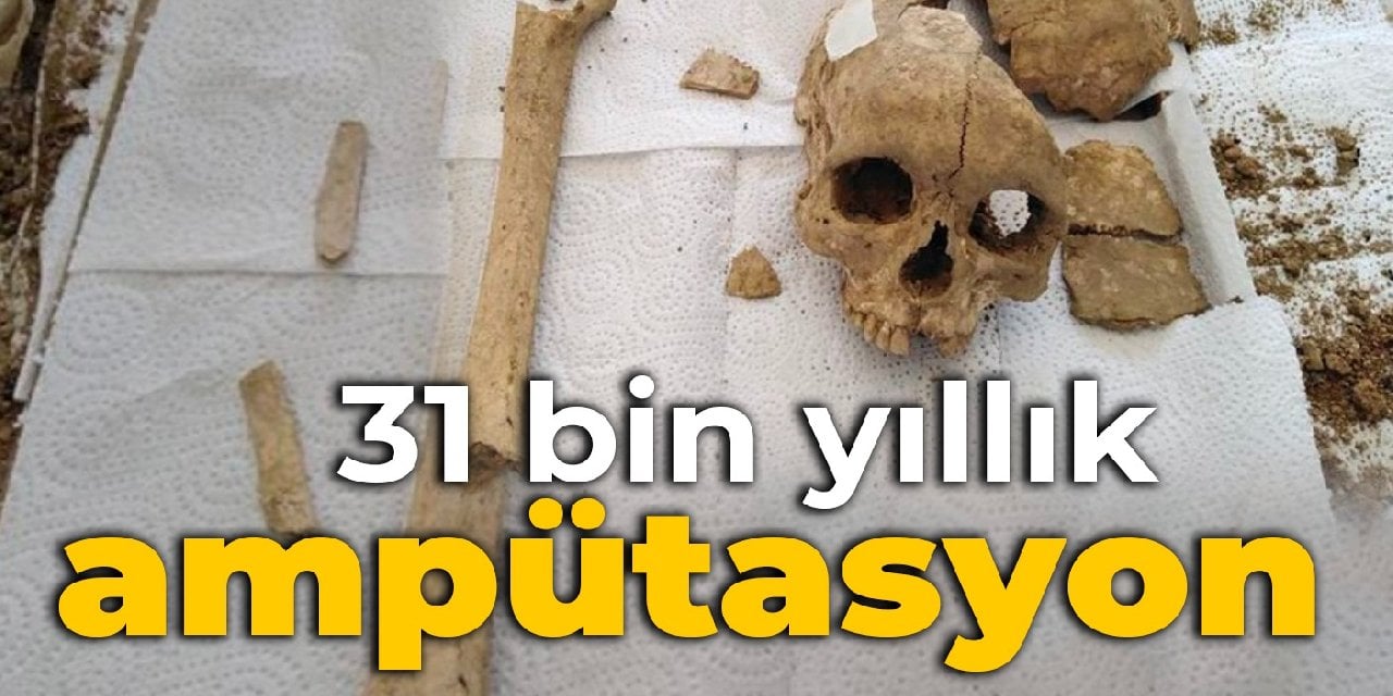 31 bin yıllık keşif: Ampütasyonun en eski örneği bulundu