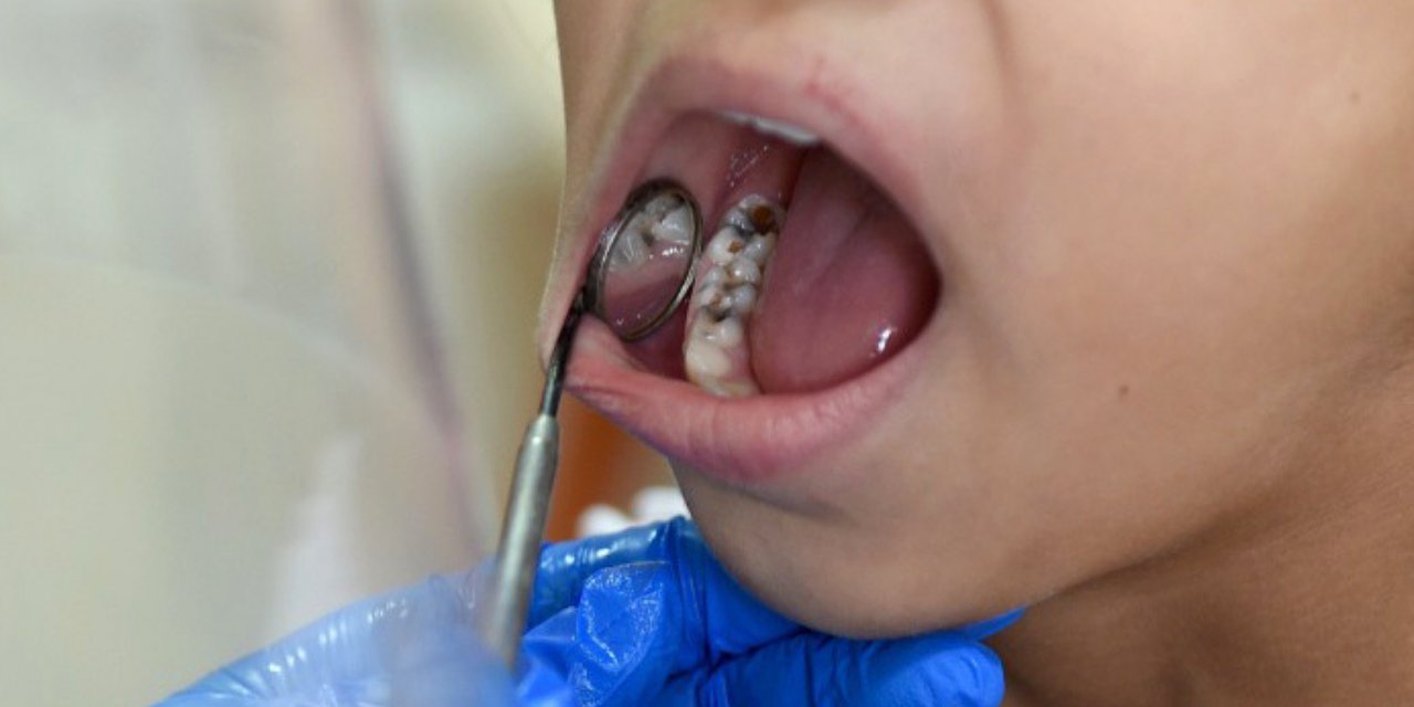 24 saatte ölüme götürüyor: Diş iltihabında 'mediastinit' riski
