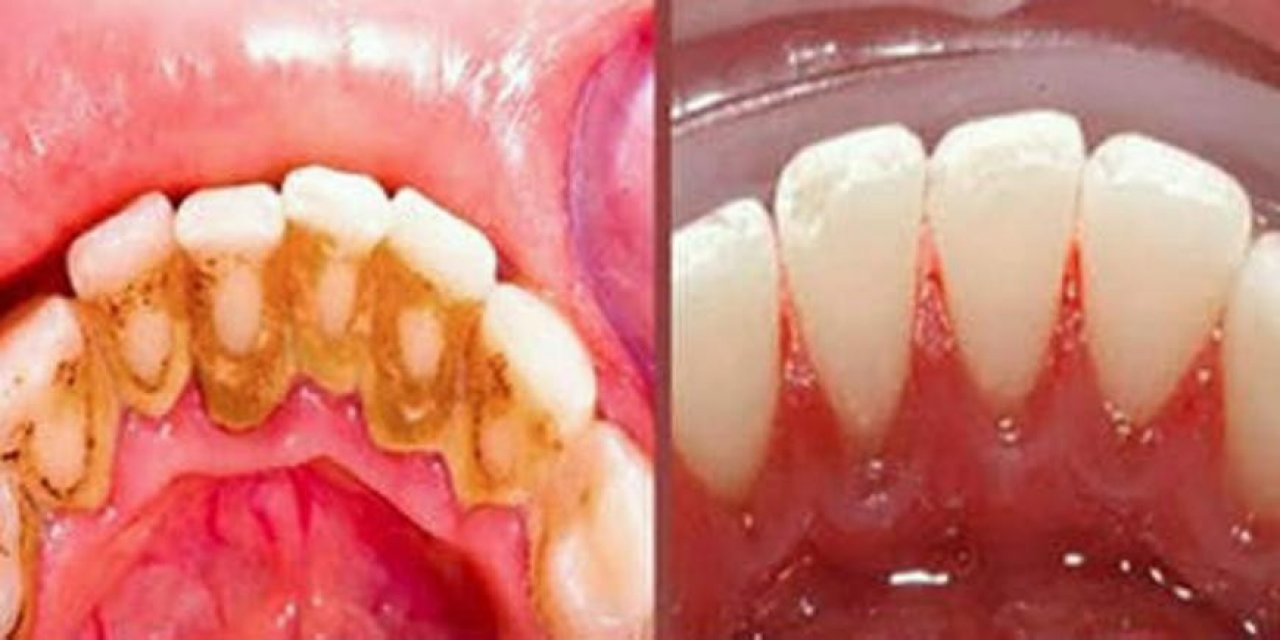 Evde bulunan malzemelerle diş tartarlarını ve plakları bu yöntemle yok edin