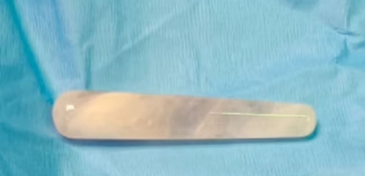 Seks oyuncağını yanlış yere sokan kadın hastanelik oldu! Ameliyatla çıkardılar...