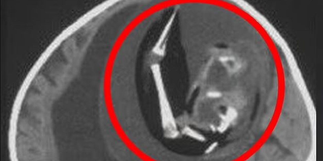 Doktora götürülen bir yaşındaki bebeğin beyninden doğmamış ikizi çıkarıldı