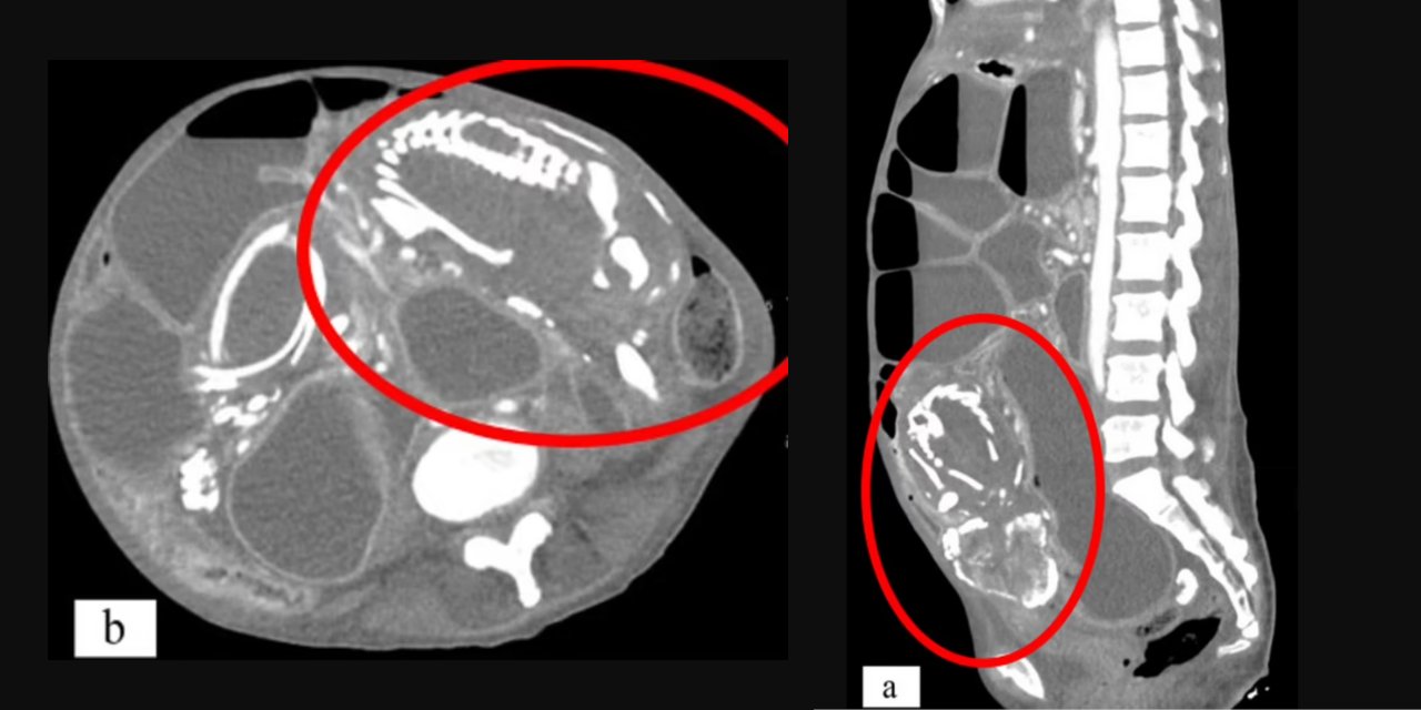 "Büyü" dedi tedaviyi reddetti... 9 yıl boyunca karnında taşıdığı bebek öldürdü