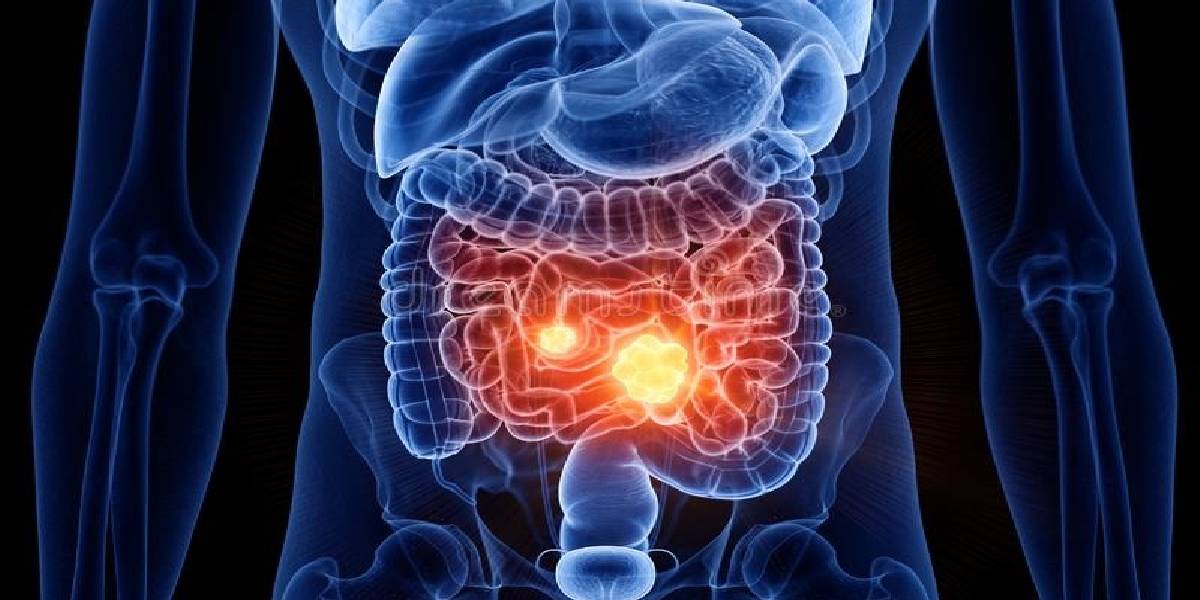 Her tuvalete gittiğinizde bunu yaşıyorsanız aman dikkat! Bağırsak kanseri olabilirsiniz:Hemen doktora görünün