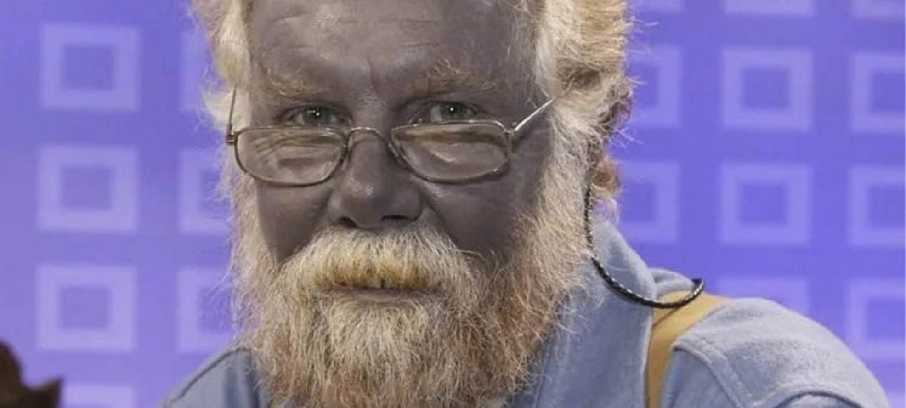 Bu gördüğünüz ne makyaj ne bilgisayar marifeti. Siz de eğer aynı hatayı yaparsanız böyle mor bir renge bürünebilirsiniz