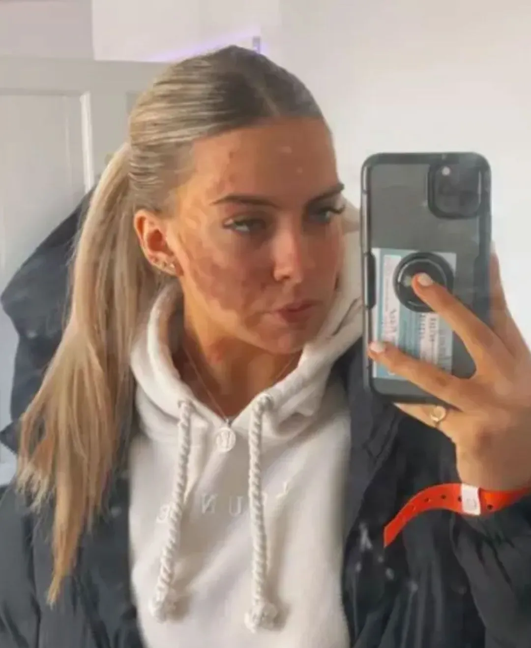 Hastalığı ona ün getirdi: Bir sivilceyle hayatı değişti