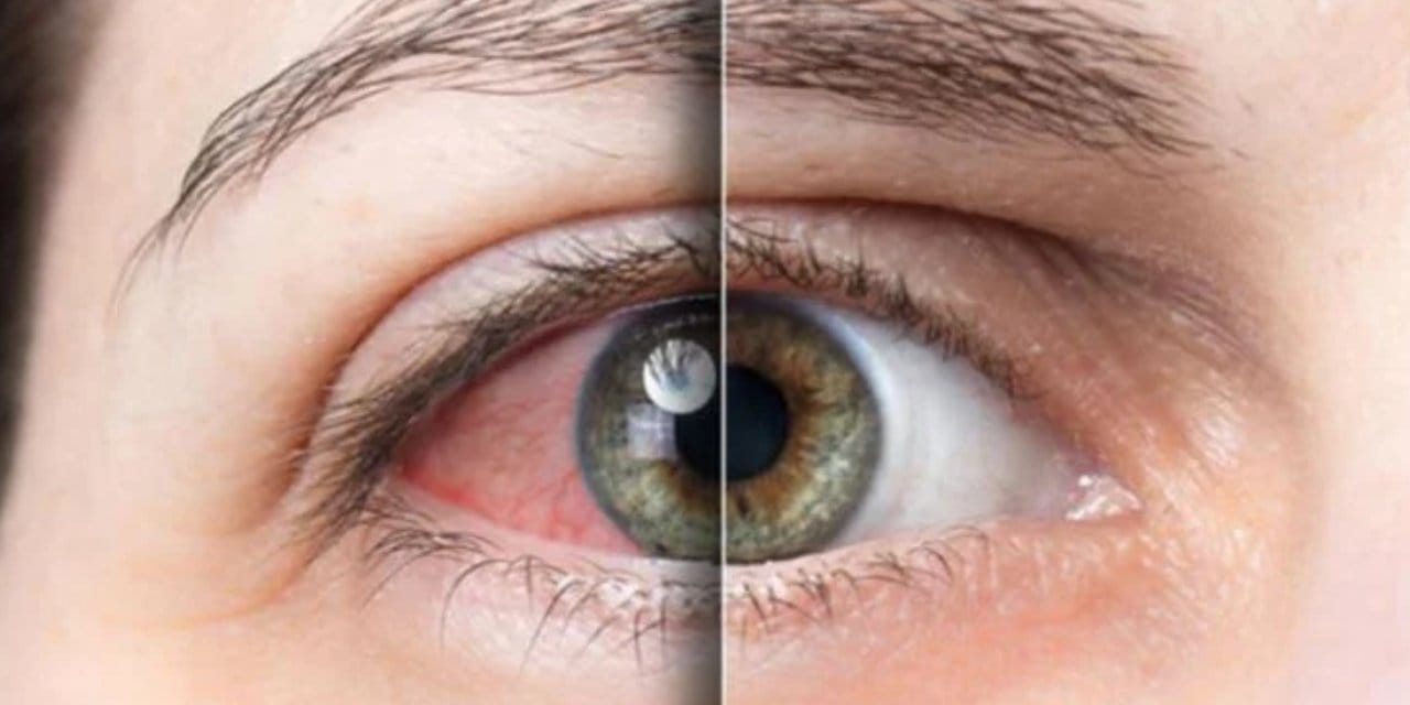 Uzmanı uyardı: Bahar aylarında göz alerjilerine dikkat!