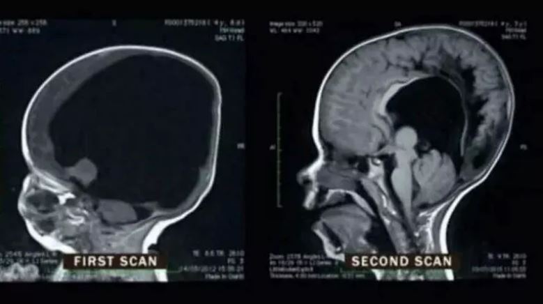 Doğduğunda beyninin yerinde sadece bir boşluk vardı, bugün 11 yaşında! Doktorların dili tutuldu