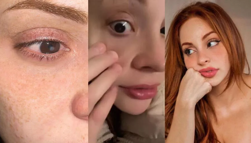 Kontak lensi hayatını kabusa çevirdi! 'Gözüme bıçak saplanmış gibi bir ağrı ile uyandım'