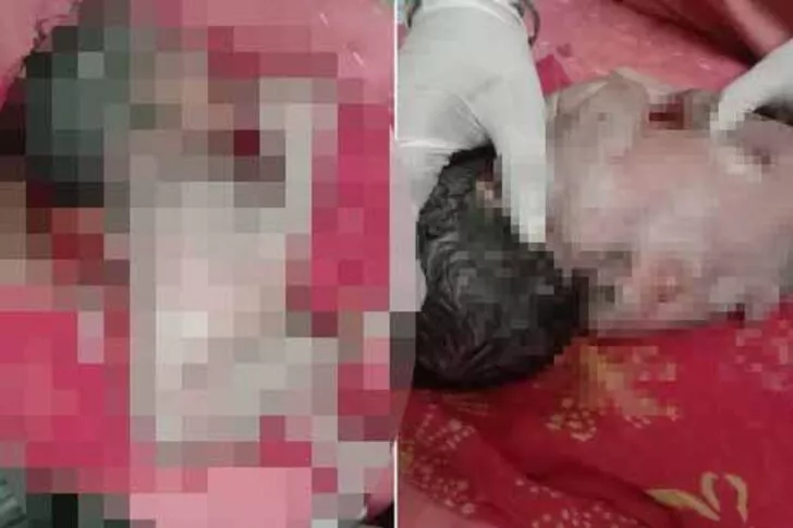 Millet görmek için hastaneye akın etti! Hindistan’da sırtında üçüncü bir kolla doğan bebek herkesi şaşırttı