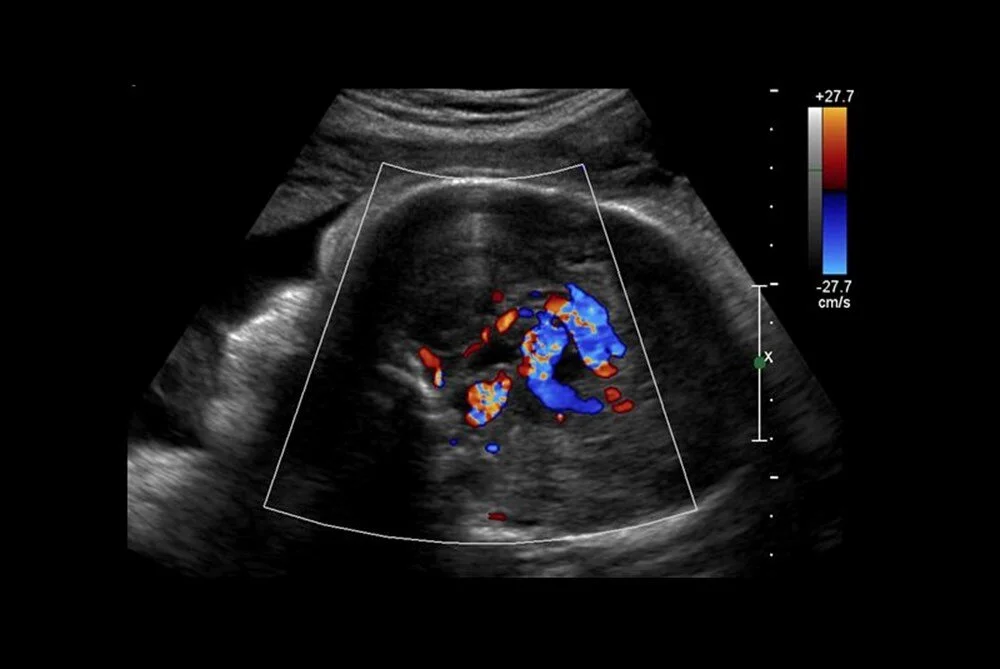 Tıp Tarihinde Bir İlk! Bebeğe Anne Karnında  Beyin Ameliyatı Yapıldı! Bebek Doğmadan Ölümden Kurtarıldı