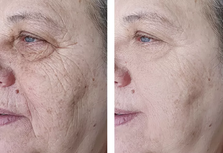 Kaz ayaklarını ve kırışıklıkları yok ederek 10 yaş gençleştiren maske tarifi