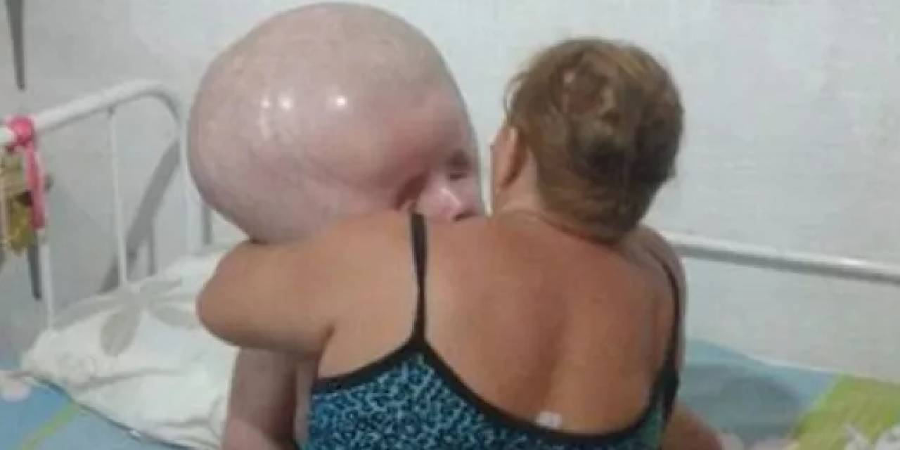 Nadir görülen bir hastalıkla dünyaya geldi! Kafasının büyümesi durdurulamayan bebeğin yaşam mücadelesini annesi böyle paylaştı