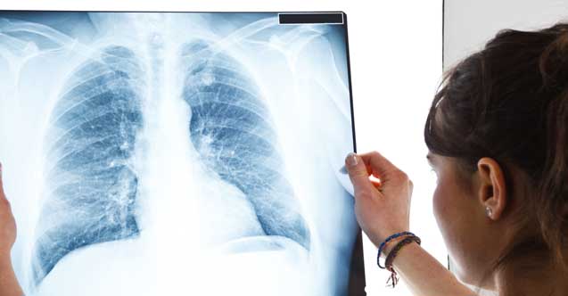 Kendi kendine sağlık testi! Bu belirtiler varsa akciğer kanseri riskiniz var demektir