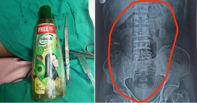 Mide ağrısıyla hastaneye gitti, doktorlar midesinden 20 cm'lik pet şişe çıkardı