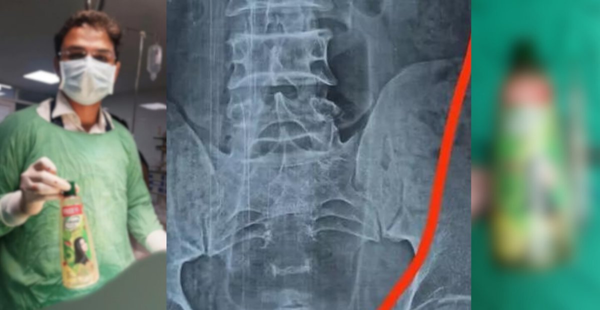 Midesinden plastik şişe çıkan kişi doktorların sorusuna cevap veremedi! Bu şişe mideye nasıl girdi? Ameliyat Saatler sürdü!