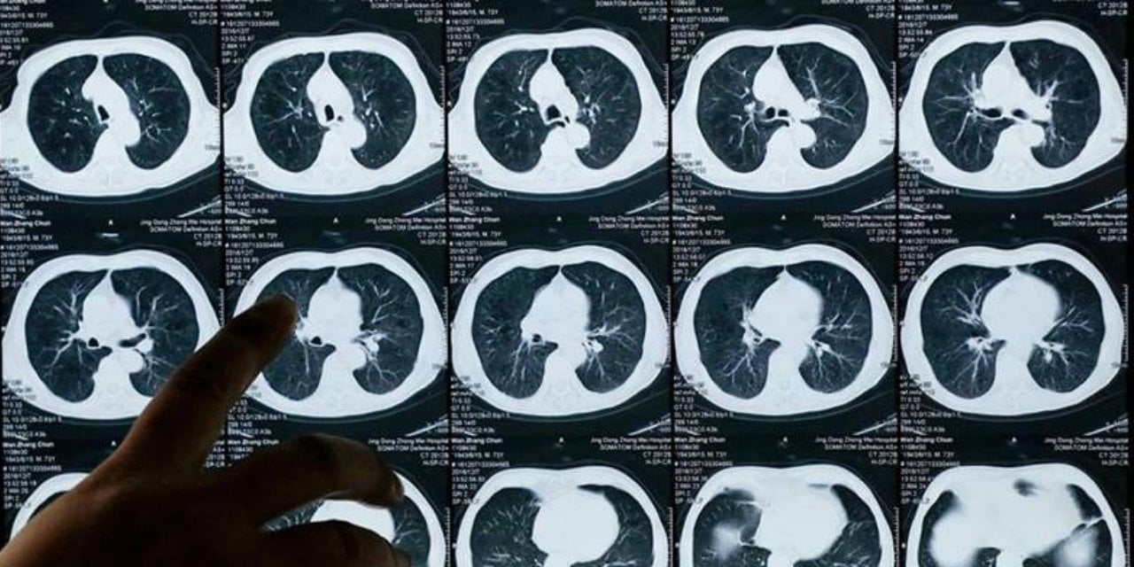 Piyasadaki bir ilacın akciğer kanseri hastalarının "ölüm riskini yarıya indirebileceği" tespit edildi