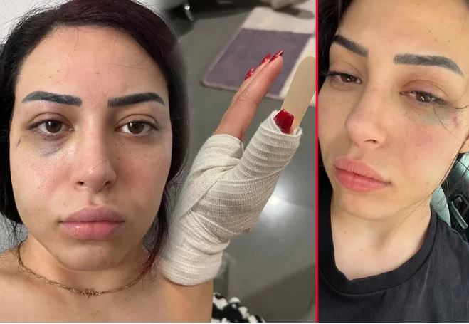 G.Kıbrıs'ta Saldırıya Uğrayan Türk Kızı  Yaşadıklarını Anlattı...