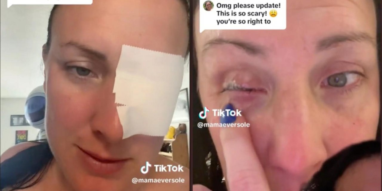 Gözüne Damla Yerine Yapıştırıcı Sıktı... Talihsiz Kadının Başına Gelmeyen Kalmadı