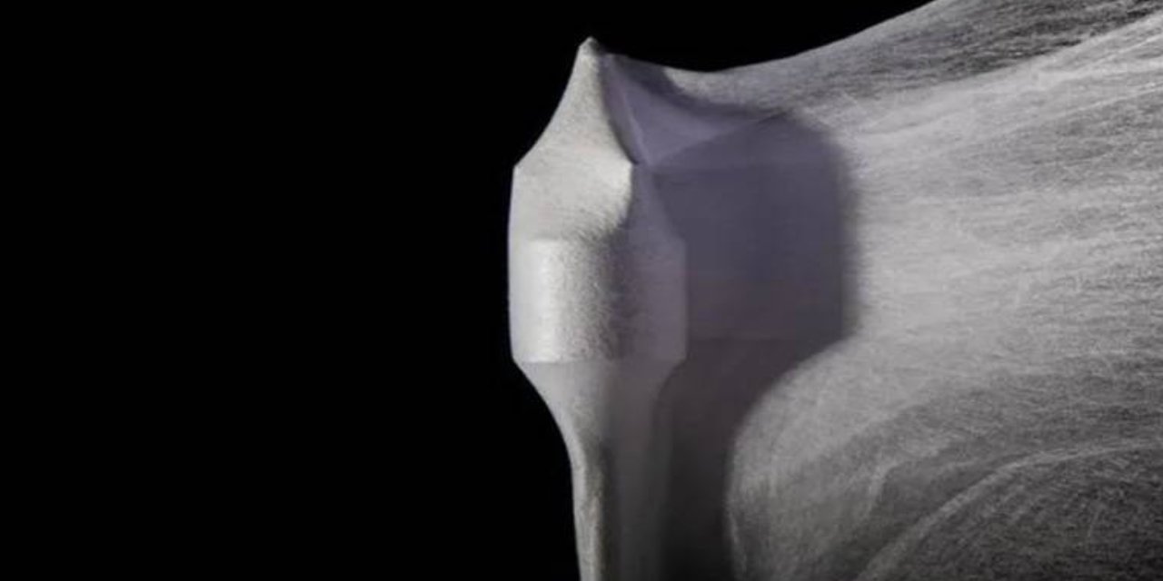 Hastayla birlikte büyüyor... Sentetik kalp kapakçığı çocuklar için yeni bir umut olabilir