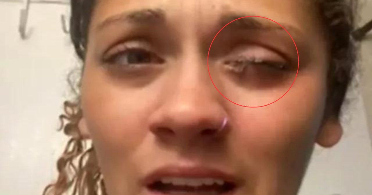 Hayatının Yanlışını Yaptı!  Yapıştırıcı ve Göz Damlasının Kutularını Karıştırdı! Gözünden Oluyordu!