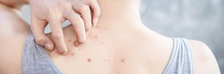 Bu yöntemle sırtınızdaki tüm sivilcelerden tek seferde kurtulun! Yaz mevsiminde sırtınızı gönül rahatlığıyla açın