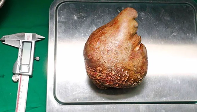 Guiness Rekorlar kitabına girdi! Bir insandan çıkarılan en büyük böbrek taşı