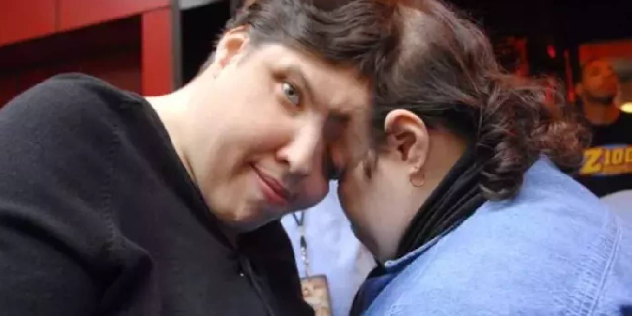 Anlattıkları gündem oldu... Yapışık ikizlerin cinsellik itirafı olay oldu! 'Kardeşim yüzünü çeviriyor'