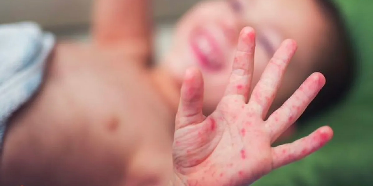 Sebebi "Düzensiz Göç" Olabilir mi? Son Zamanlarda Artan "El Ayak Ağız Hastalığı" Endişelendirdi!