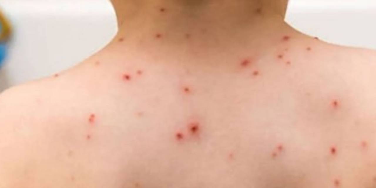 Çok kritik kızamık uyarısı: 'Düzensiz göç ile alakalı bir şeyler yapılmazsa kızamık, kısa zamanda salgına dönecektir'