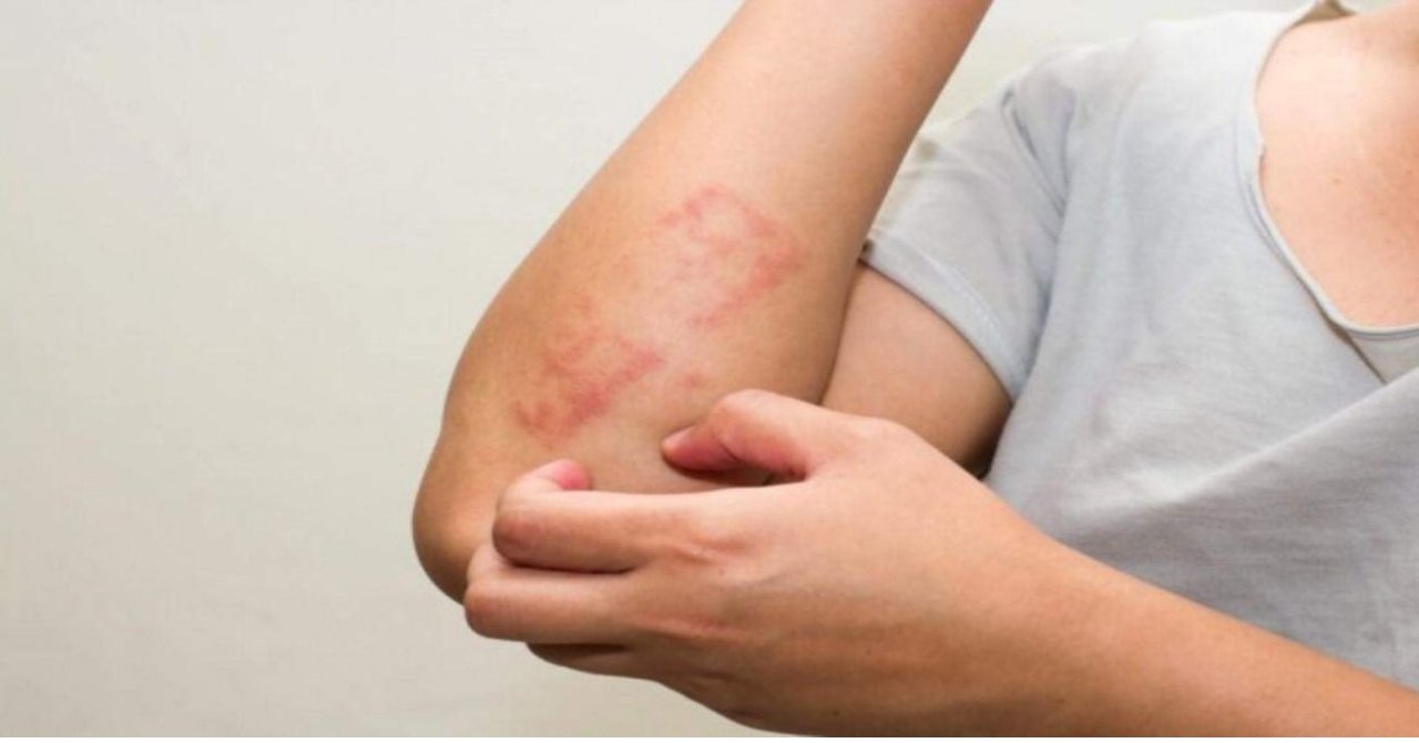 Yaz alerjisinden ilaçsız kurtulmanın 11 basit yolu