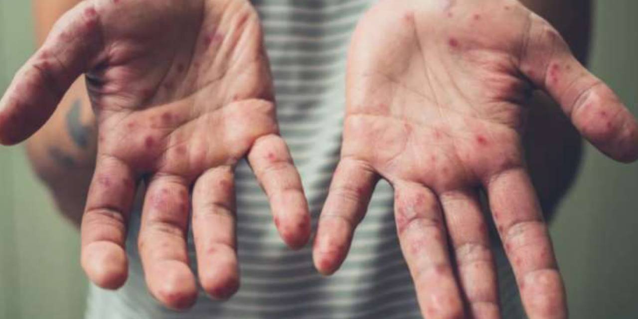 Kızamıkta vakalar patladı, kritik uyarı: 'Koronavirüsten daha ölümcül, tek çare aşı'... Bu belirtilere dikkat!