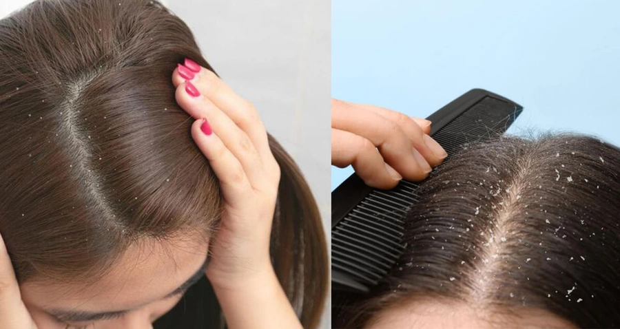 Saç diplerindeki kaşıntı, kabuklanma ve egzamadan eser bırakmıyor! Şampuanın içine 1 damla eklemek mikropları öldürüyor