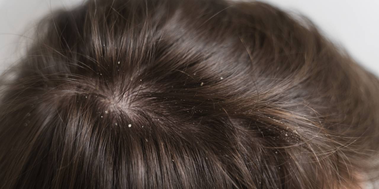 2 Malzemeyle Kepeğe Son! Bu Yöntemle Artık Kepek Derdiniz Olmayacak!