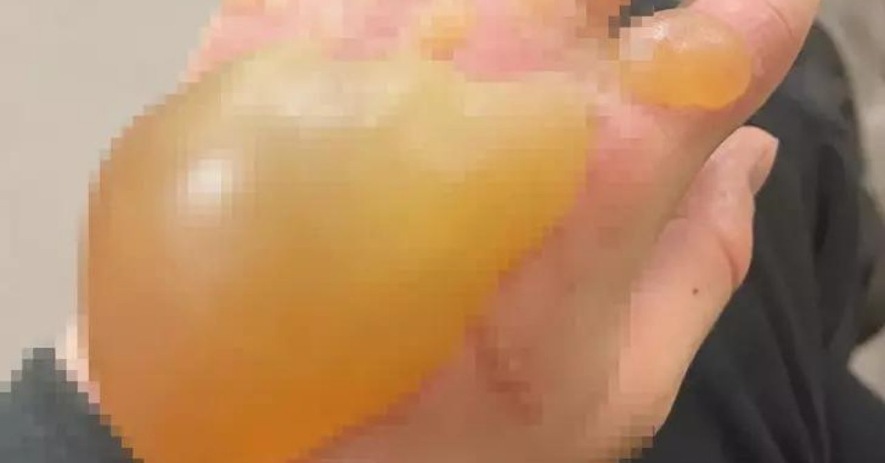 Eli bir anda davul gibi şişti! Ne olduğunu anlamadan acıdan bayıldı!