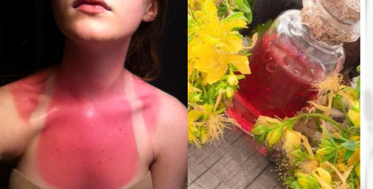 Yaz Aylarında Güneş Yanıklarının Kurtarıcısı Bu Yağı Evde Kendiniz Yapın!