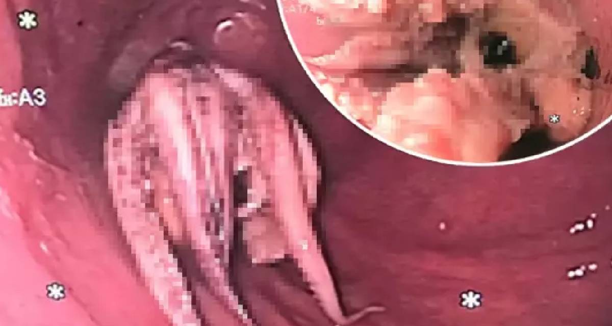 Sürekli olarak kusan hastanın boğazından öyle bir şey çıktı ki... Doktorları bile şaşkına çevirdi...