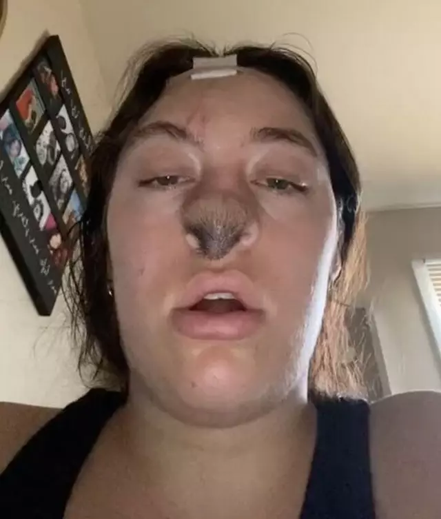 Köpek saldırısından sonra burnuna deri nakli yaptırdı! “Burnumun üzerinde tüyler çıkmaya başladı”