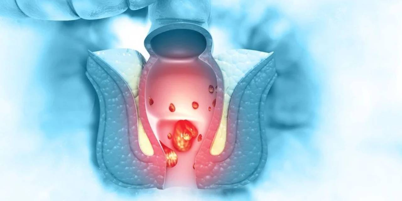 Basur Nedir? Basura Ne İyi Gelir?