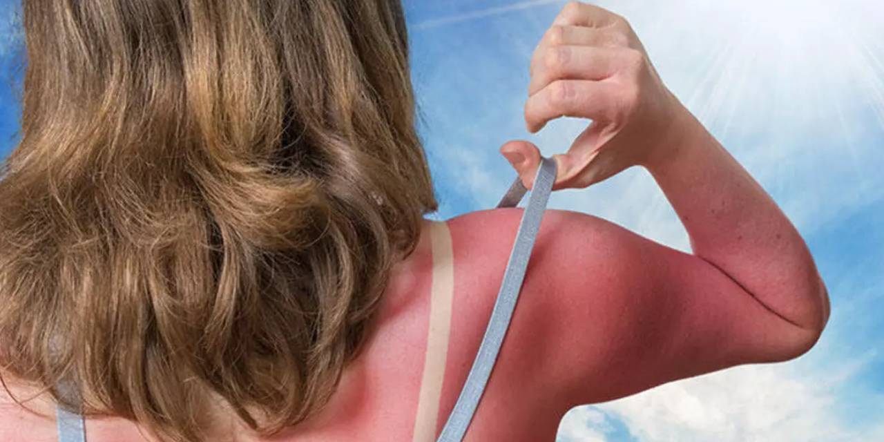 Amele Yanığı Nedir? Nasıl Geçer? Amele Yanığı Eşitlenir Mi?