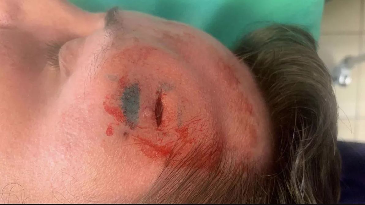 Sürekli Başı Ağrıyordu, Doktorlar Alnından 15 Santimlik Solucan Çıkardı